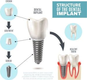 Dental Implant Beverly Hills
