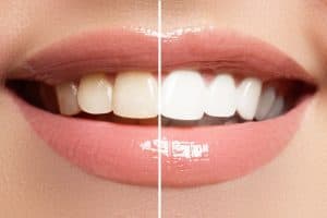Professional Teeth Whitening Beverly Hills