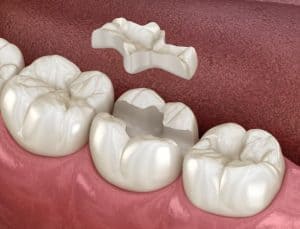 Composite resin dental fillings